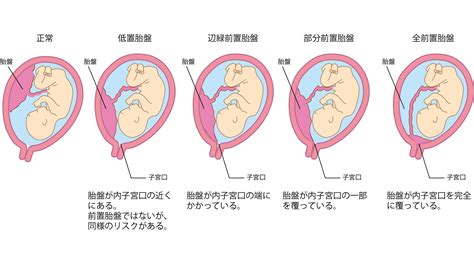 仙人掌 低位性前置胎盤